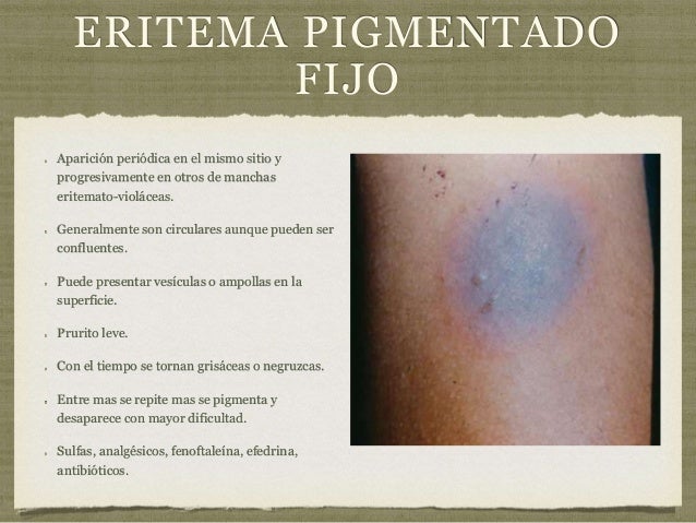 eritema pigmentado fijo por medicamentos